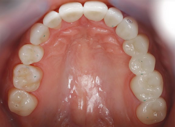 Der Oberkiefer zeigt die neue harmonische Verteilung der Zähne mit den von ...