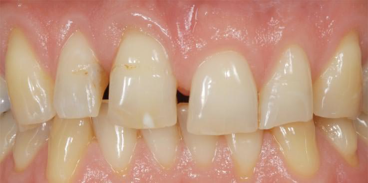 VORHER: vor ästhetischer Zahnfleisch-Transplanation