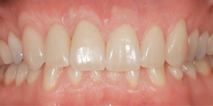 NACHHER: ästhetische Zahnfleisch-Transplanation