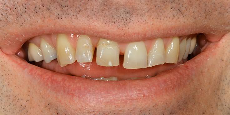 VORHER: vor ästhetischer Zahnfleisch-Transplanation