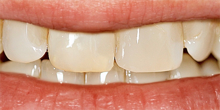 Sich nach grau wurzelbehandlung zahn verfärbt Internes Bleaching: