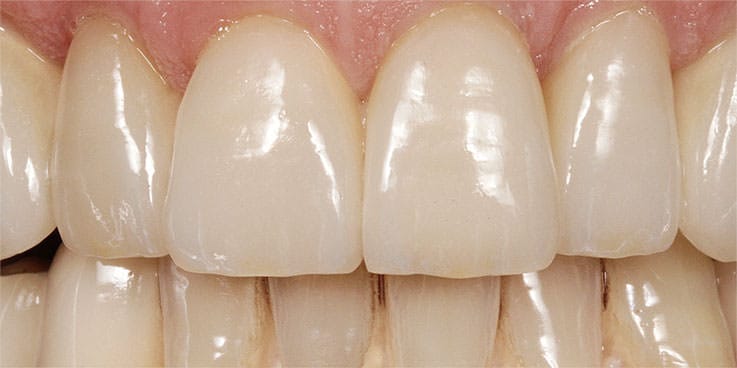 Zwischen grosse schneidezähnen zahnlücke den Zahnlücke/ obere