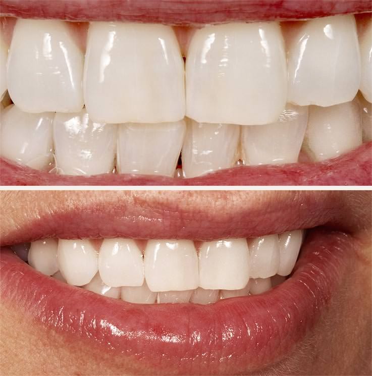 Nach dem Bleaching II: Aufhellung aller Zähne um mehrere Farbstufen. / Dr. Rüdiger Hansen, Zahnarzt München