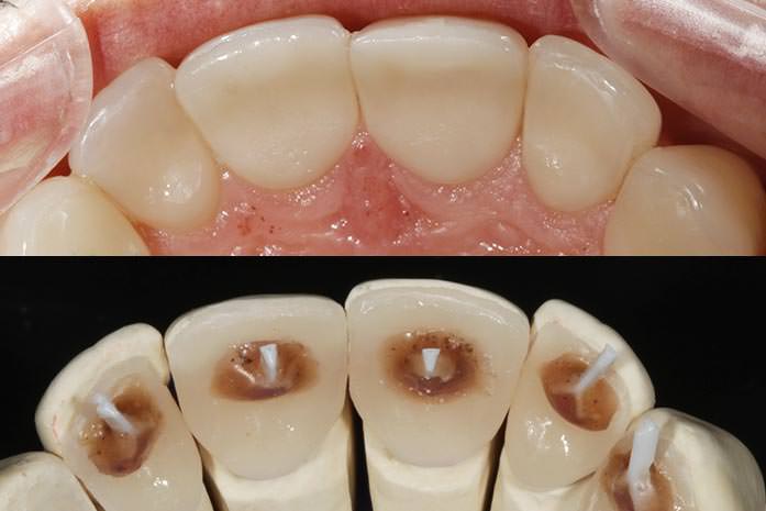 Palatinale Veneers auf der Rückseite der Schneide- und Eckzähne. / Dr. Rüdiger Hansen, Zahnarzt München