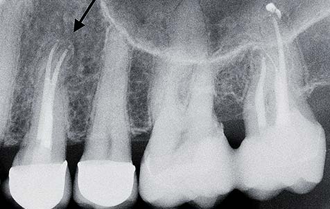 Zahn wird grau wurzelbehandelter Wurzelbehandelter Zahn